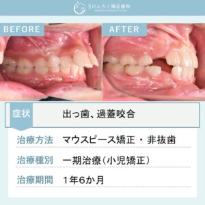 ８歳女子：小児矯正用のマウスピース矯正装置で出っ歯を改善したケース