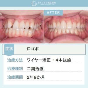 27歳女性：引っ込んでいる歯と口の閉じにくさを４本抜歯で改善したケース