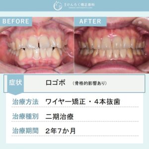 26歳女性：口の閉じにくさを上下顎小臼歯４本抜歯で改善したケース