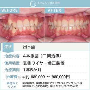 15歳女子：出っ歯を抜歯して１年５か月で治したケース