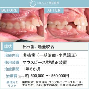 ８歳女子：小児矯正用のマウスピース矯正装置で出っ歯を改善したケース
