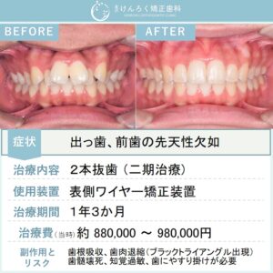 17歳女子：抜歯をして出っ歯を１年３か月で治したケース（先天性欠如あり)