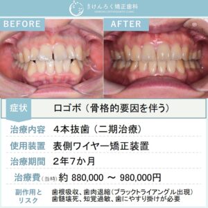 26歳女性：口の閉じにくさを上下顎小臼歯４本抜歯で改善したケース