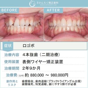 27歳女性：引っ込んでいる歯と口の閉じにくさを４本抜歯で改善したケース