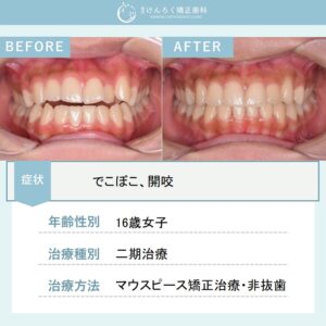 前歯が噛み合っていない「開咬」をマウスピース矯正装置で改善したケース