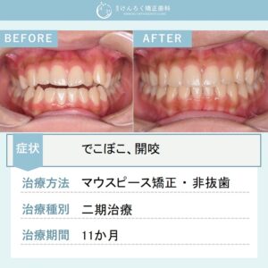 16歳女子：前歯が噛み合っていない「開咬」をマウスピース矯正装置で改善したケース