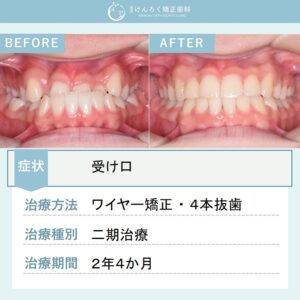 16歳女子：受け口と歯列正中のずれを抜歯による矯正治療で改善したケース