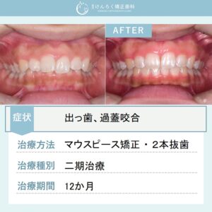 14歳女子：出っ歯とかみ合わせの深さをマウスピース矯正で１年という短期間で治したケース