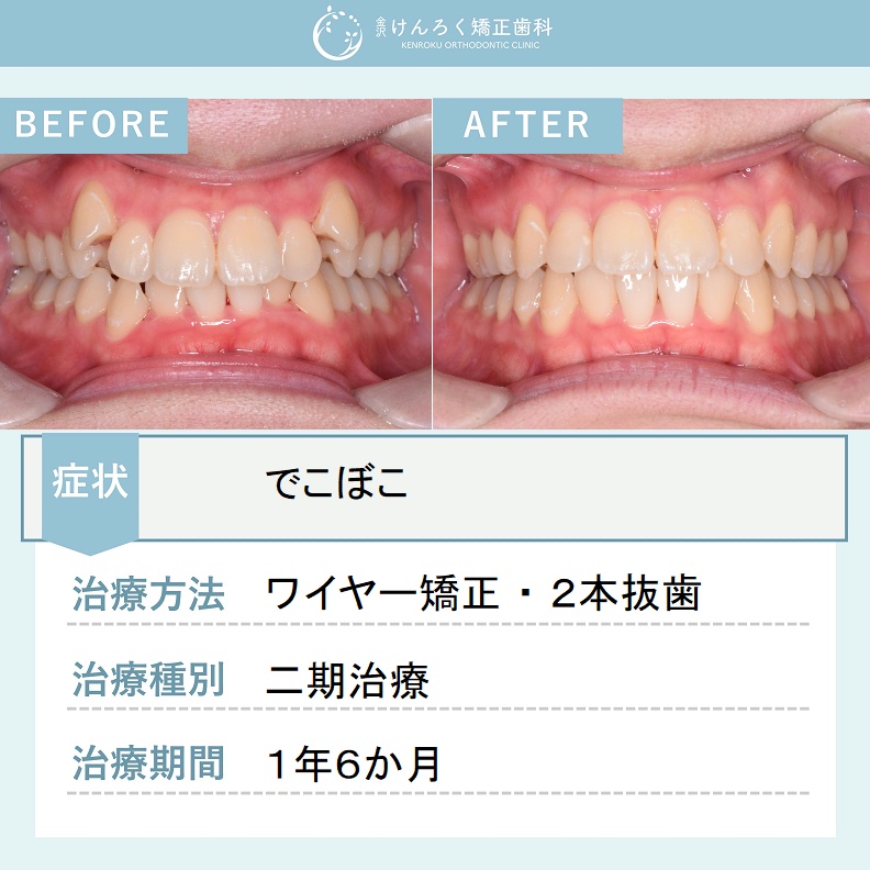 豊富な実績と症例写真が充実｜金沢けんろく矯正歯科