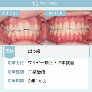 12歳女子：著しい出っ歯を抜歯による矯正治療にて引っ込めたケース