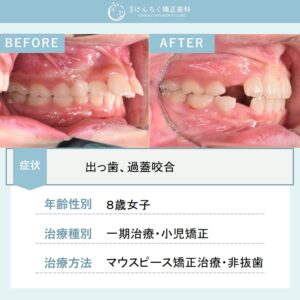 小児矯正用のマウスピース矯正装置で出っ歯を改善したケース