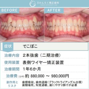 23歳女性：八重歯を１年半で治したケース