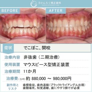 16歳女子：前歯が噛み合っていない「開咬」をマウスピース矯正装置で改善したケース