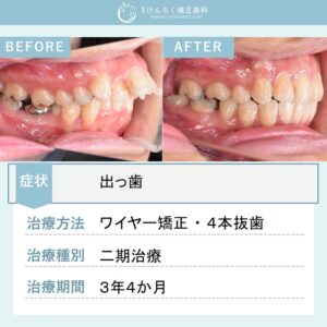 24歳女性：予後不良な奥歯を抜歯して真横になっていた親知らずを利用して並べたケース