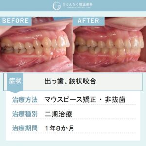 25歳女性：前歯の深いかみ合わせと奥歯の鋏状咬合を非抜歯で治したケース