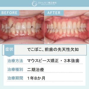 21歳女性：下顎前歯に先天性欠如があっても抜歯を利用して上下歯列の真ん中を一致させたケース