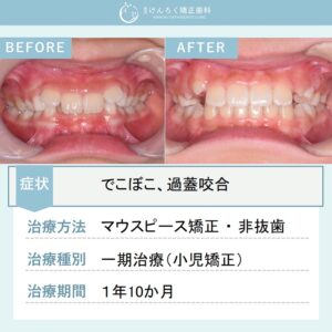 ８歳女子：子供の過蓋咬合をマウスピース矯正で改善したケース