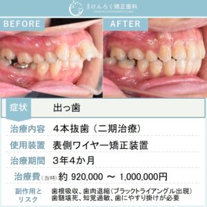 24歳女性：予後不良な奥歯を抜歯して真横になっていた親知らずを利用して並べたケース