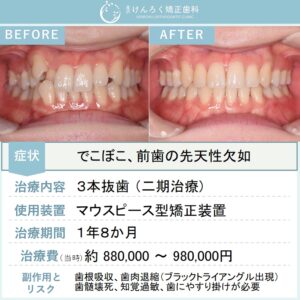 21歳女性：下顎前歯に先天性欠如があっても抜歯を利用して上下歯列の真ん中を一致させたケース