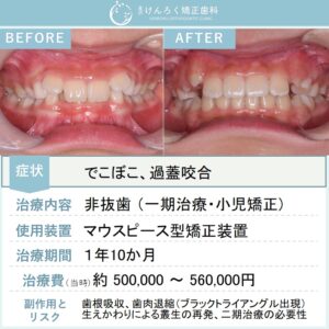 ８歳女子：子供の過蓋咬合をマウスピース矯正で改善したケース