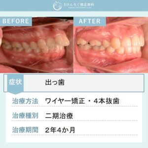 19歳女性：口が閉じにくさを小臼歯４本抜歯をしてワイヤー矯正で治療したケース