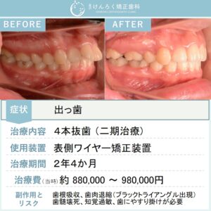 19歳女性：口が閉じにくさを小臼歯４本抜歯をしてワイヤー矯正で治療したケース