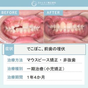 ８歳女子：生えてこない前歯を開窓牽引して咬合誘導したケース