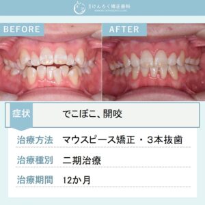 17歳女子：３本抜歯方針にて出っ歯を１年で治したケース