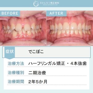 25歳女性：重度のでこぼことかみ合わせのずれを抜歯＋奥歯の遠心移動で治療したケース