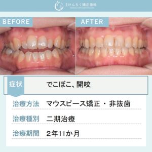 49歳女性：開咬をマウスピース矯正装置にて非抜歯で改善したケース