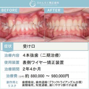 16歳女子：受け口と歯列正中のずれを抜歯による矯正治療で改善したケース
