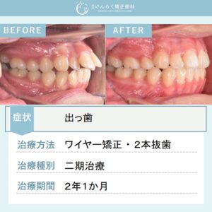12歳女子：著しい出っ歯を抜歯による矯正治療にて引っ込めたケース