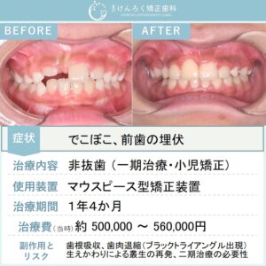 ８歳女子：生えてこない前歯を開窓牽引して咬合誘導したケース