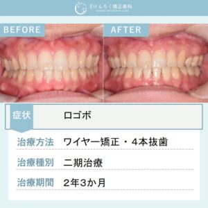 23歳女性：４本抜歯して口ゴボを改善したケース