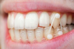 インビザラインのゴムかけとは？種類・装着時間・噛み合わせへの効果を解説