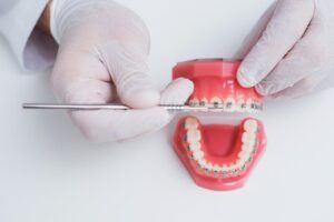 ワイヤー矯正の期間はどのくらい？症例別の目安と期間を左右する要因