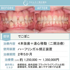 25歳女性：重度のでこぼことかみ合わせのずれを抜歯＋奥歯の遠心移動で治療したケース