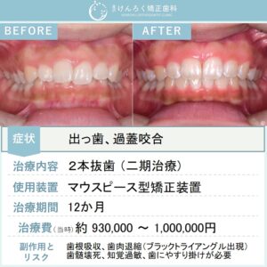 14歳女子：出っ歯とかみ合わせの深さをマウスピース矯正で１年という短期間で治したケース