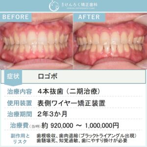 23歳女性：４本抜歯して口ゴボを改善したケース