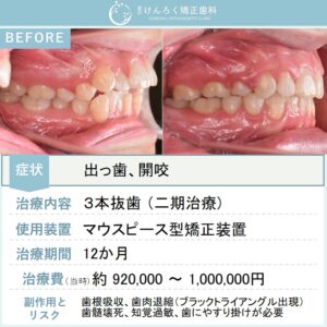 17歳女子：３本抜歯方針にて出っ歯を１年で治したケース