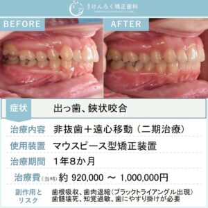 25歳女性：前歯の深いかみ合わせと奥歯の鋏状咬合を非抜歯で治したケース