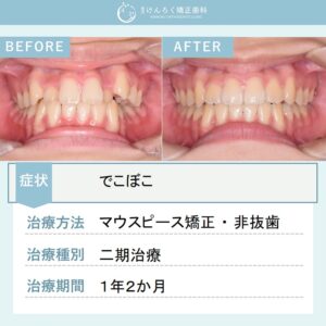13歳女子：でこぼこをマウスピース矯正装置で歯を抜かずに治したケース
