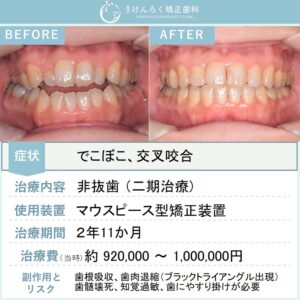 49歳女性：開咬をマウスピース矯正装置にて非抜歯で改善したケース