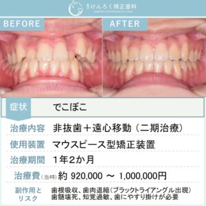 13歳女子：でこぼこをマウスピース矯正装置で歯を抜かずに治したケース