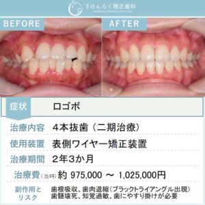 20歳女性：口ゴボを抜歯＋歯科矯正用アンカースクリューで改善したケース