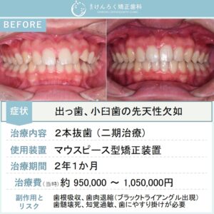 14歳男子：すきっ歯と出っ歯をマウスピース矯正で治したケース