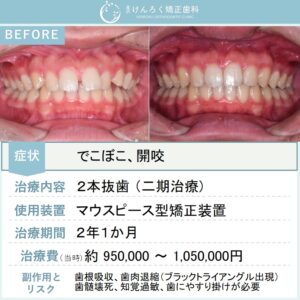 14歳男子：すきっ歯と出っ歯をマウスピース矯正で治したケース