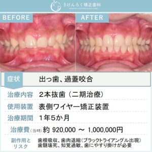 14歳男子：出っ歯とかみ合わせの深さをワイヤー矯正装置で治したケース